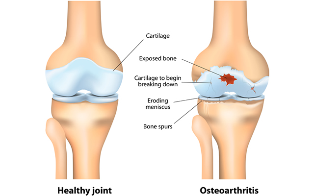Osteoarthritis​